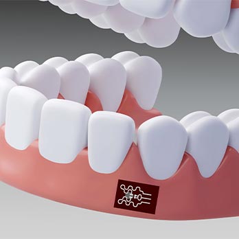 A graphic of a jaw showing a sensor on the gums below the teeth